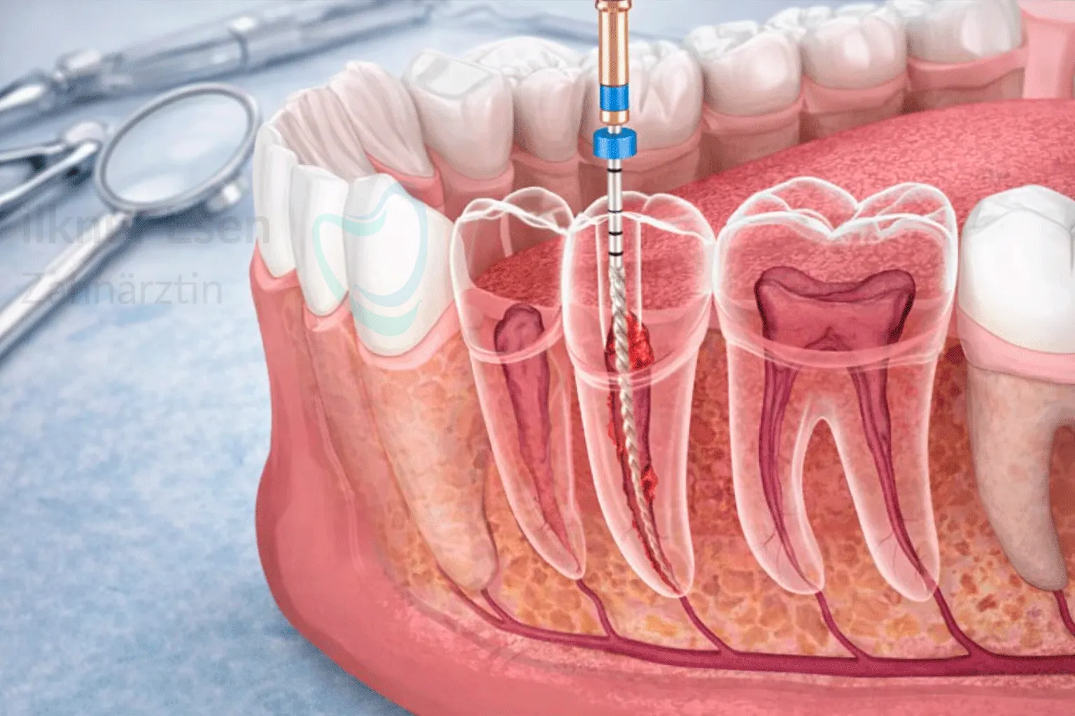 Wurzelkanalbehandlung